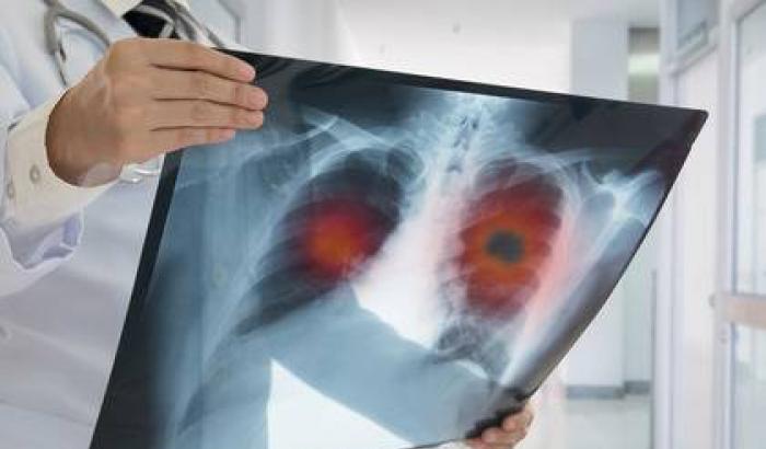 Tumore al polmone, chi sono i pazienti non curabili con l'immunoterapia
