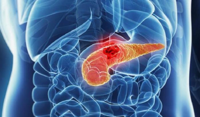 Tumore al pancreas: la ricerca italiana individua una nuova terapia