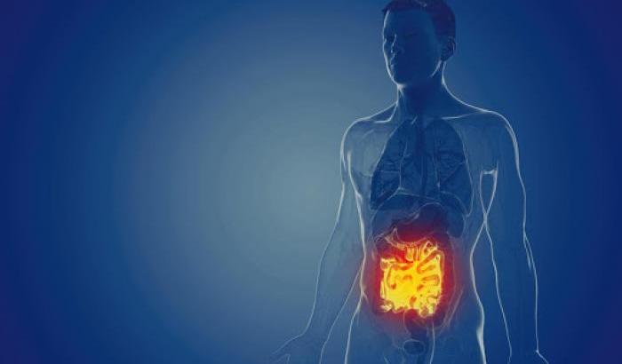 Colite ulcerosa e Crohn: si sperimenta la cura con le cellule staminali